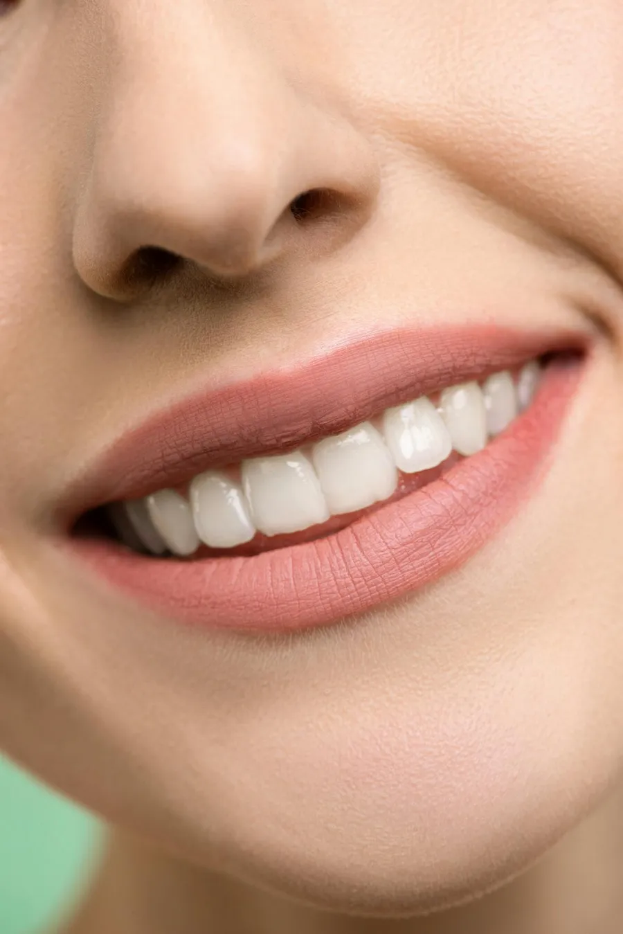 Beautiful Hollywood Smile result achieved at Taki Dent Antalya — E-max porcelain veneers delivering a natural, radiant smile