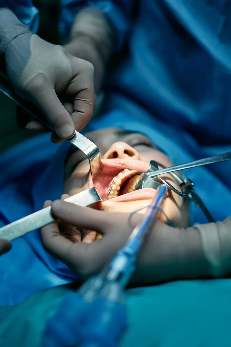 Surgical team performing an All-on-4 dental implant procedure at Taki Dent Antalya — a specialist oral surgery team led by Dr. Barış Kıprıtoglu, ITI Fellow