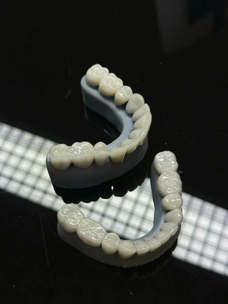 Custom porcelain veneer shells crafted in Taki Dent's in-house ceramics laboratory in Antalya — each veneer matched to natural tooth shade