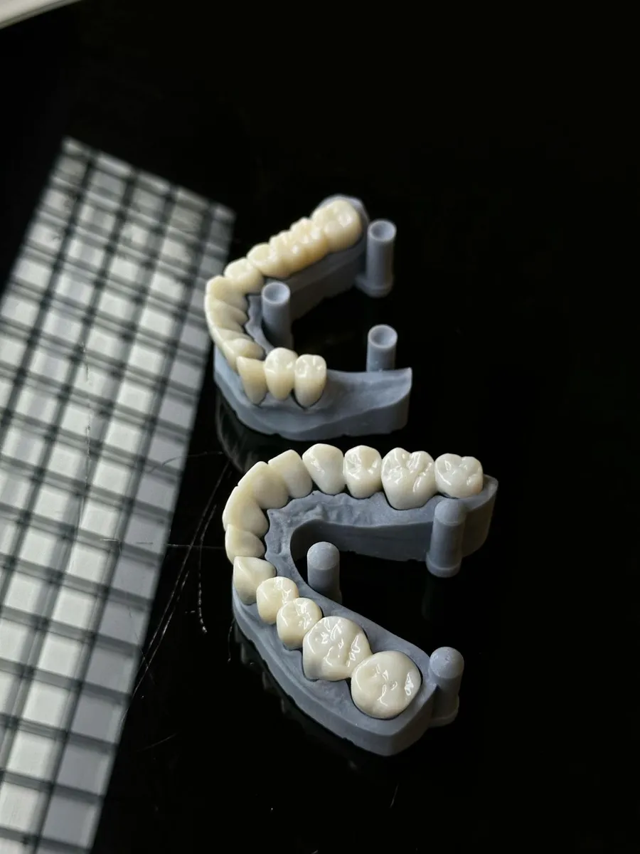Zirconia crown being inspected at a dental laboratory — the same CAD/CAM-milled restorations produced at Taki Dent's in-house lab in Antalya